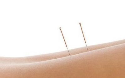 Acupuncture: An Introduction