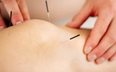 Acupuncture and Sports Medicine