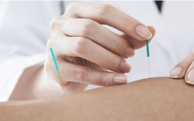 FAQs About Acupuncture
