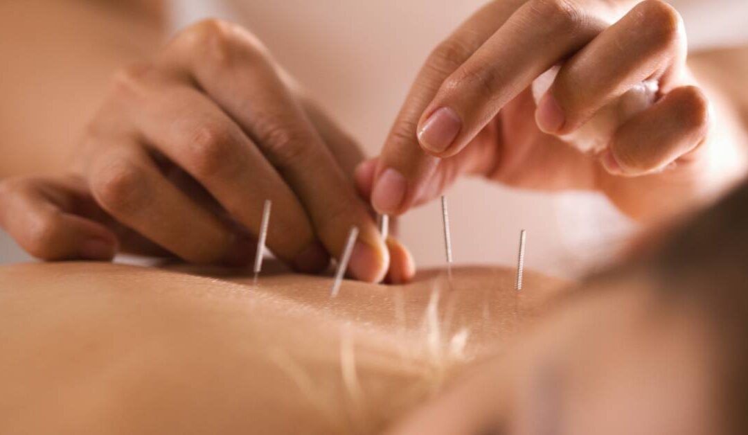 Targeting Pain Points: How Acupuncture Offers Relief for Common Ailments